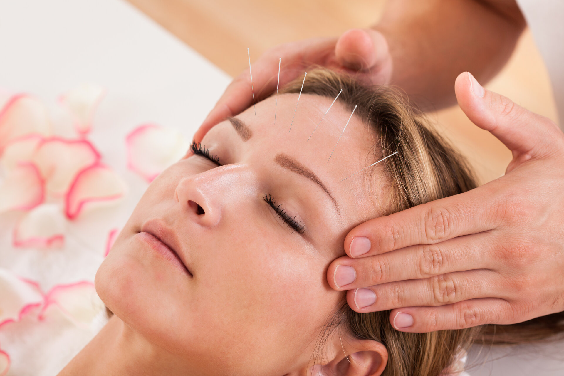 Frau, die sich einer Akupunkturbehandlung mit einer Reihe feiner Nadeln unterzieht, die in die Haut ihrer Stirn eingeführt werden